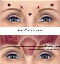 BOTOX for Migraines | BOTOX for Headaches | Migraine Relief Center