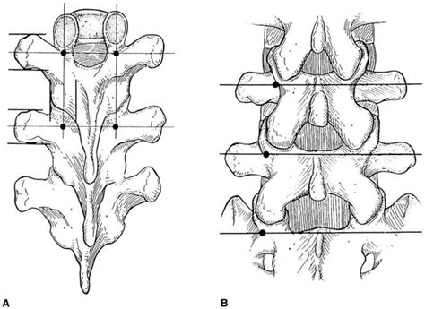 Thoracolumbar Burst Fractures Spine Orthobullets