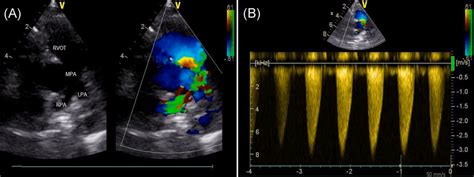 Preoperative Transthoracic Echocardiogram Showing Parasternal Short