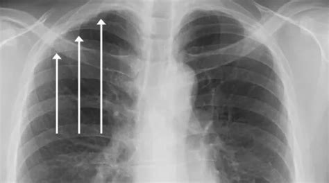 Pleural Thickening Causes Symptoms And Treatment