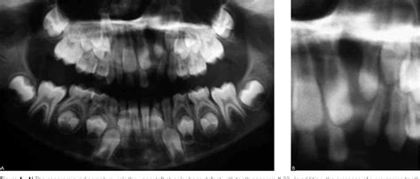 Figure From Reconstruction Of Alveolar Cleft With Allogenous Bone