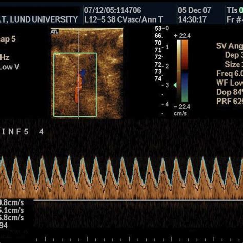 Doppler Signals Of Blood Velocity Recorded From The Umbilical Artery Of