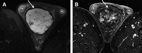 Mr Imaging Of The Testicular And Extratesticular Tumors Radiology Key