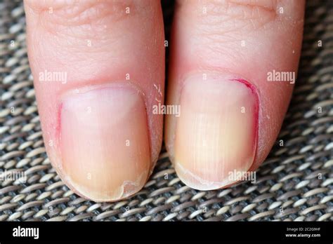 Dry skin with brittle splitting and peeling nails from biting Stock ...