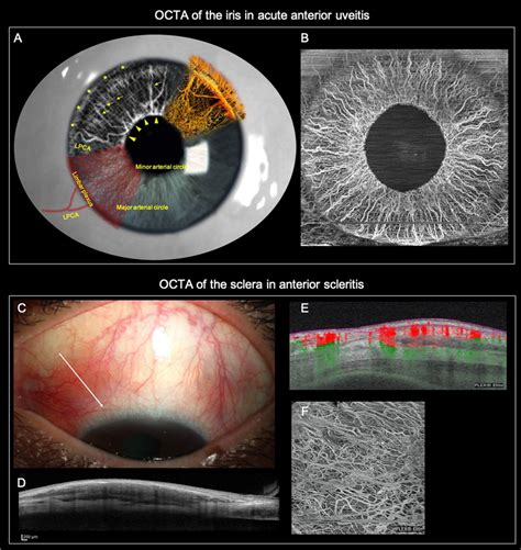 The Superior Panel Shows Octa Of The Iris In A Patient With Acute