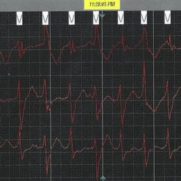 Holter Monitor Tracing Demonstrating An Episode Of Non Sustained