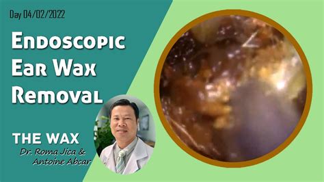 Endoscopic Ear Wax Removal And Cleaning 234 Youtube