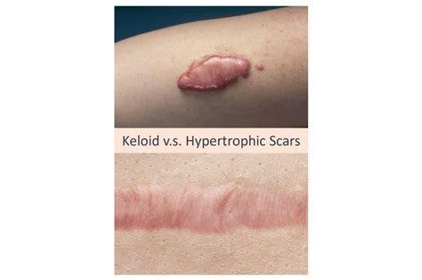 Keloid Acne Scars What Are They And How To Get Rid Of Them Dream