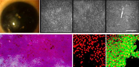 In Vivo Confocal Microscopy In Diagnosis Of Limbal Stem Cell Deficiency