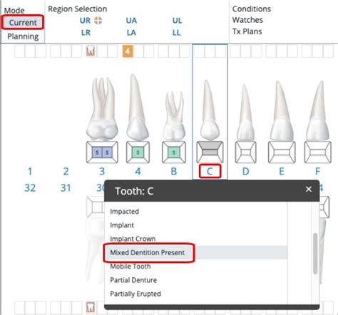 How To Chart Mixed Dentition Carestream Dental