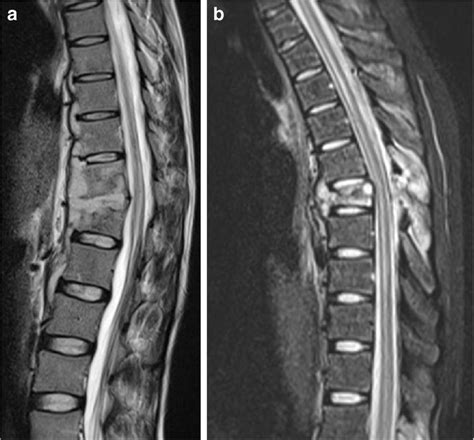 Tuberculous Osteomyelitis Vs Chronic Recurrent Multifocal