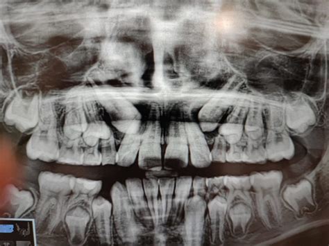 La Importancia De Realizar Radiograf As A Los A Os Centre Dental M