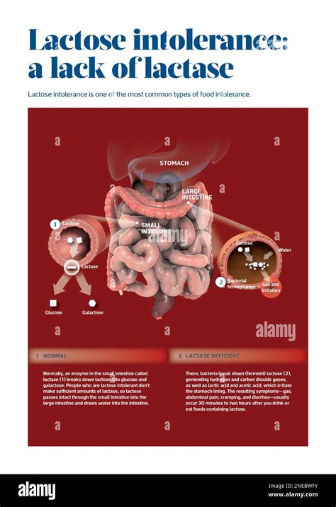 Infographic About Lactose Intolerance One Of The Most Common Types Of