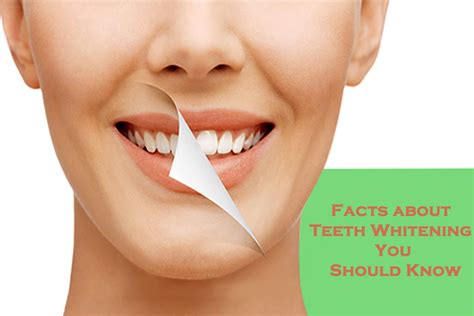 Facts About Teeth Whitening You Should Know