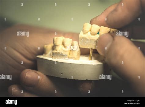 Dental Prosthesis Stock Photo Alamy