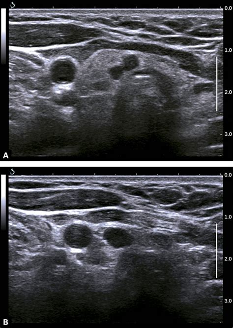 Ultrasonografia Tarczycy Cz 7 Podostre Ziarniniakowe Zapalenie