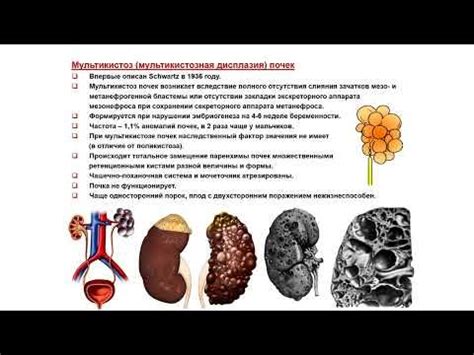 УЗИ. Доктор Иогансен. Выпуск 72. Аномалии развития почек и мочеточников ...