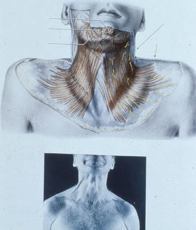 Anatomy Posterior Triangle Of The Neck Flashcards Quizlet