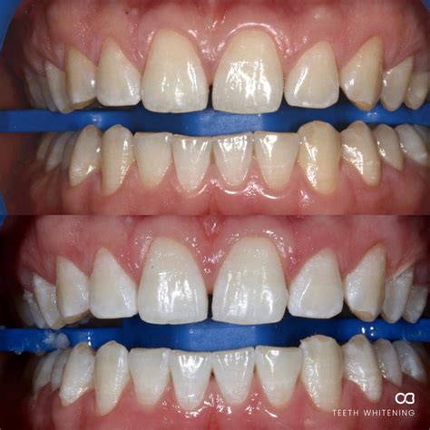 Cosmetic Dentistry Gold Coast Before And After Oasis Dental Studio