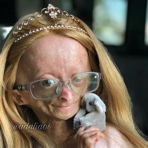 Adalia Rose La Pequeña Youtuber Con Envejecimiento Prematuro Que