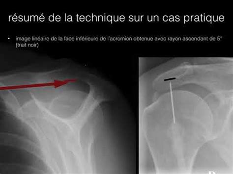 Bursographie Infiltration Bsad Sous Guidage Radiographique Youtube