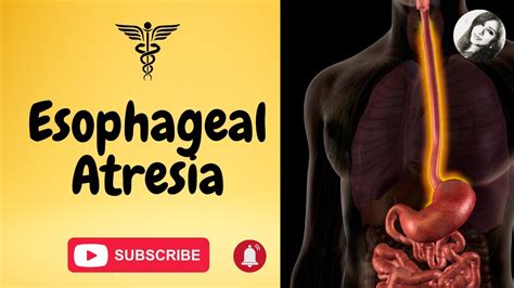 Esophageal Atresia And Tracheoesophageal Fistula Causes Types Symptoms Diagnosis And Treatment