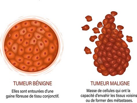 Tumeur maligne et tumeur bénigne quelles différences