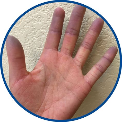 Raynaud S Phenomenon Scleroderma Complications And Treatments