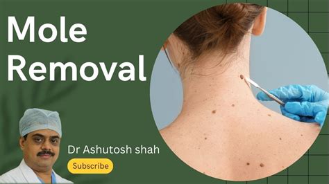 Laser for Mole Removal Birthmark Removal चहर स नशन पमपल मरक