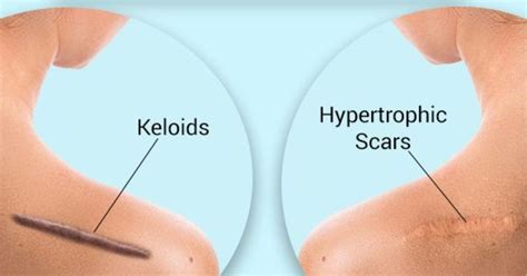 Understanding Keloid Scars Genova Skincare