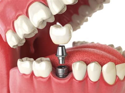 Are Dental Implants Permanent? — Ridge View Dental