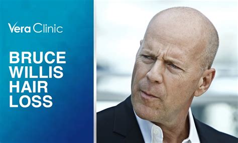 Bruce Willis Hair Loss: A Story of Confidence and Charisma