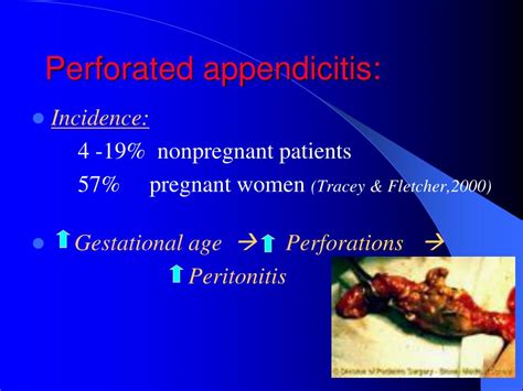 Ppt Appendicitis During Pregnancy Powerpoint Presentation Free Download Id 6403331