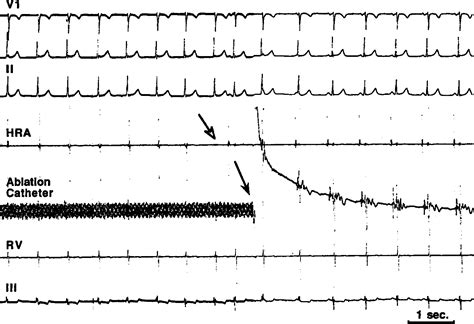 Pdf Analysis Of Junctional Ectopy During Radiofrequency Ablation Of