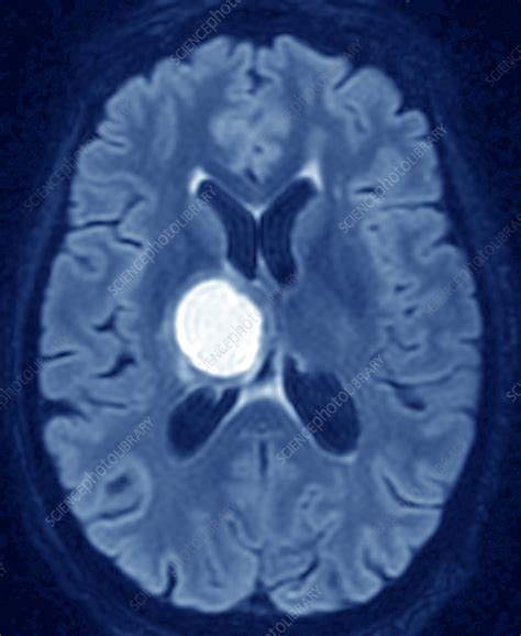 Secondary Brain Cancer Mri Scan Stock Image C Science