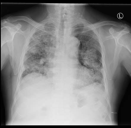 Silicosis Radiology Reference Article Radiopaedia Org