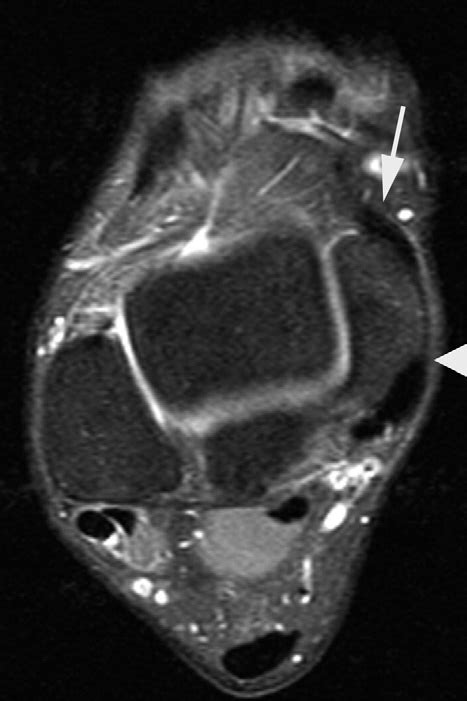 Axial Fse T2 Weighted With Fat Saturation Mri Image Showing The Origin