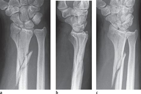 17 Trauma Of The Distal Forearm Radiology Key