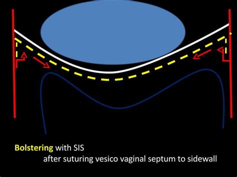 Vaginal Paravaginal Sidespecific Repair Ppt