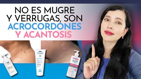 NO ES MUGRE Y VERRUGAS EN EL CUELLO ES ACANTOSIS Y ACROCORDONES