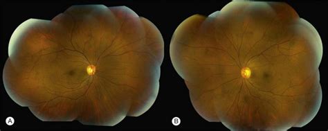 Autoimmune Retinopathies Clinical Gate