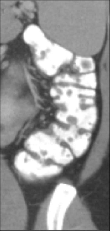 Computed Tomography Of The Abdomen And Pelvis With Oral And Intravenous