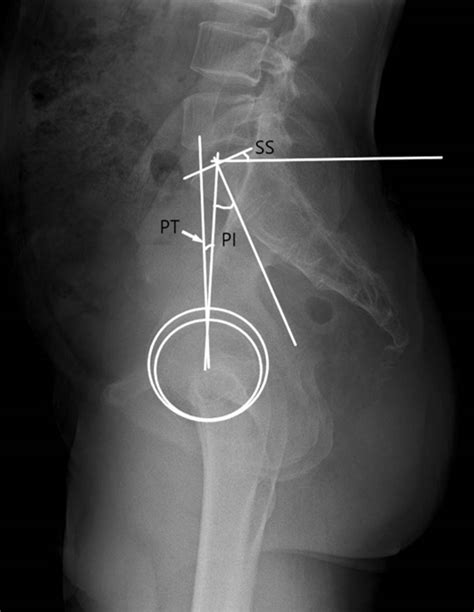 Pelvic Tilt Xray