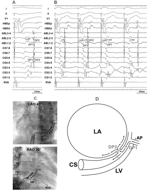 A Surface And Intracardiac Electrograms During Ventricular Pacing At