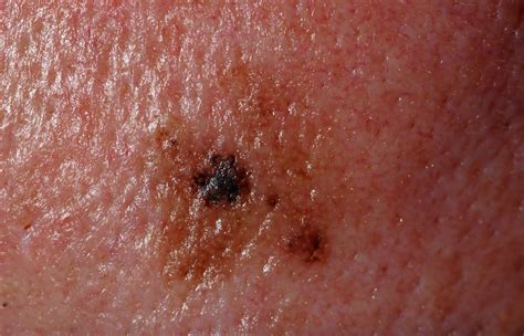 Melanoma In Situ Photos Symptoms And Pictures