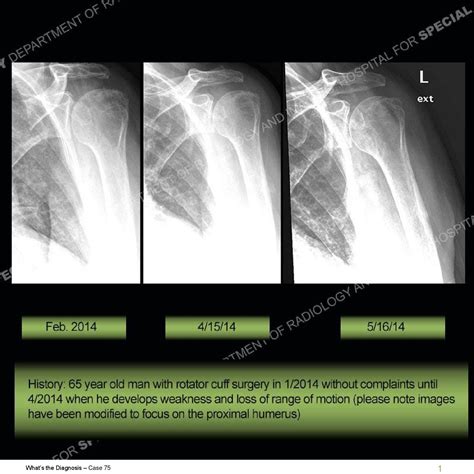 Hss Diagnosis Case 75 By Hospital For Special Surgery Issuu