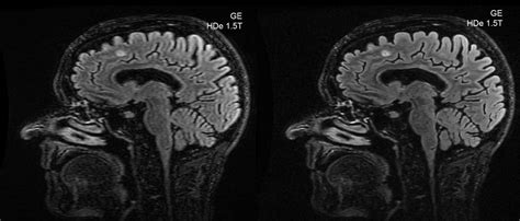 AI Superresolution Questions And Answers In MRI