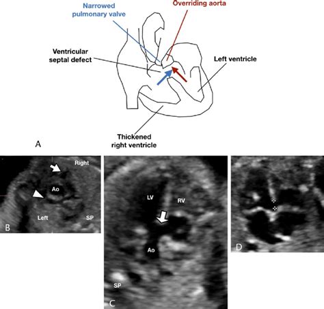 Tetralogy Of Fallot A Diagram Depicts Cardiac Configuration In Tof Download Scientific