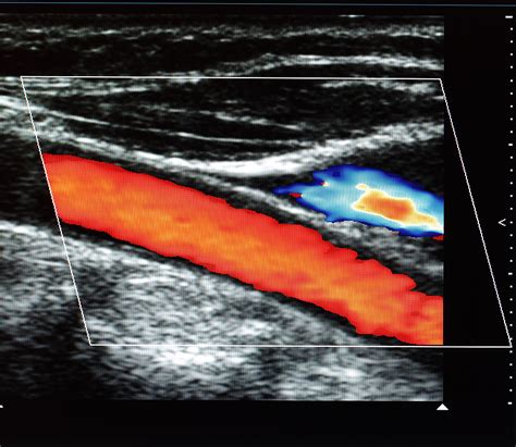 CAROTID ULTRASOUND 2 Carolina Primary Care Carolina Primary Care