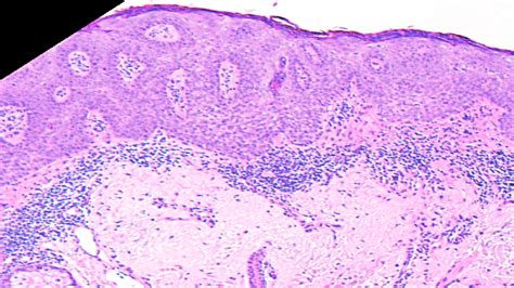 Squamous Cell Carcinoma In Situ Histology